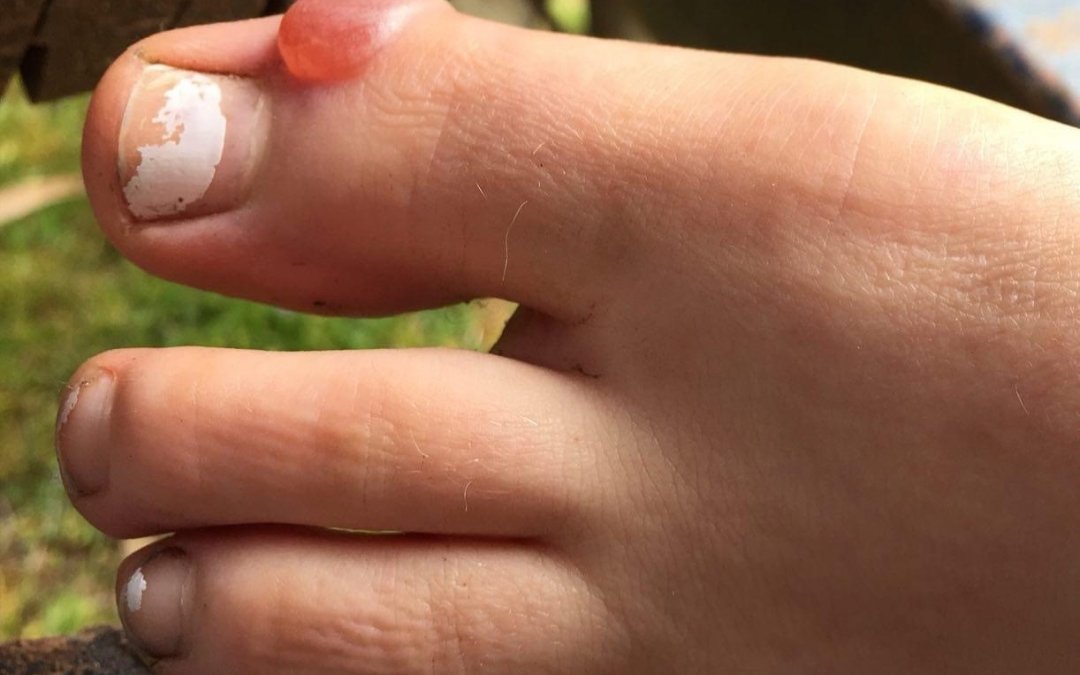 HOW TO PREVENT AND TREAT BLISTERS