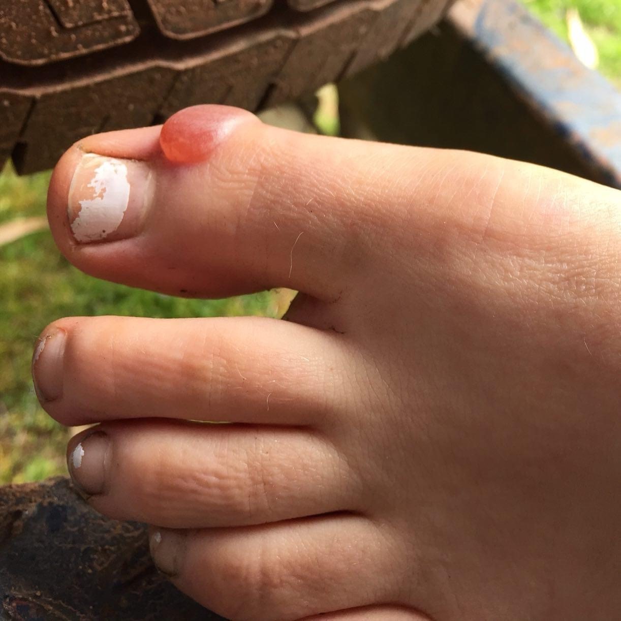 Help - toenail fell off now what (with pic sorry) | Mumsnet